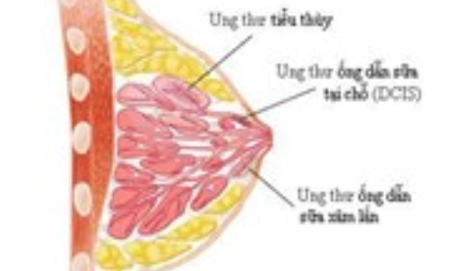 Các hóa chất hàng ngày tiềm ẩn nguy cơ gây ung thư vú